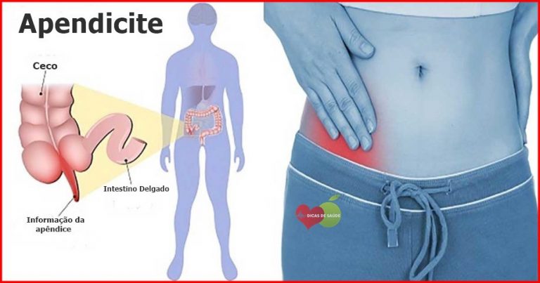 Apendicite Causas Sintomas E Tratamentos Dicas De Sa De