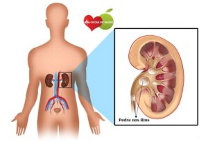 Os Principais Sintomas Do C Lculo Renal Dicas De Sa De