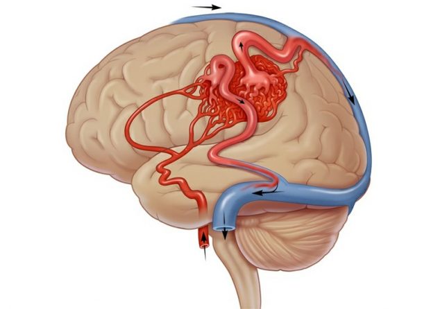 Malforma O Arteriovenosa Cerebral O Que Causas E Tratamentos