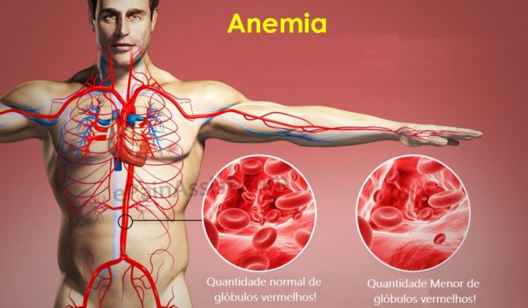 Anemia O Que é Causas Sintomas E Tratamentos Dicas De Saúde 