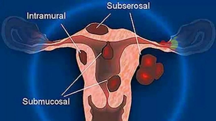 Miomas Uterinos Causas Sintomas E Tratamentos 1 Dicas De Saúde