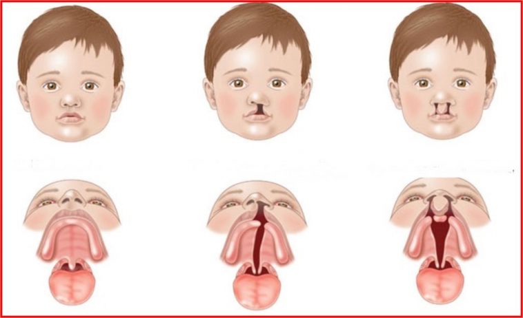Lábio Leporino O Que é Causas E Tratamento Dicas De Saúde 3870