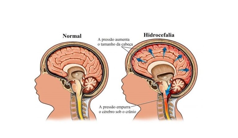 Os 10 Principais Sintomas Da Hidrocefalia Dicas De Saúde 3156