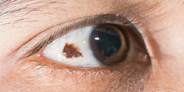 Melanoma Ocular O Que é Sintomas E Tratamentos 【atualizado】 9907