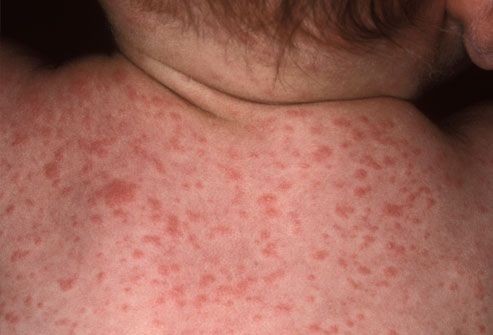 Roseola O Que E Causas E Tratamentos Dicas De Saude