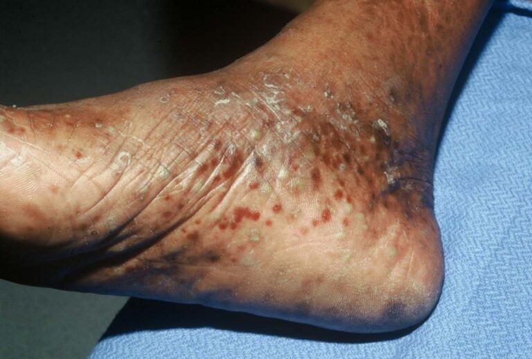Eczema Disidrotico 768x518 