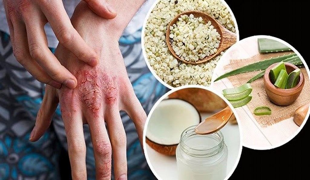 Os 9 Remédios Caseiros Para Tratar Eczema | Dicas De Saúde