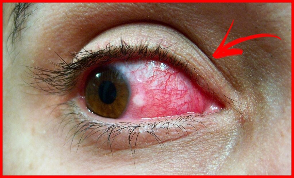 Os 10 Remédios Caseiros Para Tratar Olhos Vermelhos | Dicas de Saúde