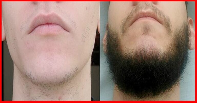 8 Remédios Caseiros Para Crescer A Barba Rápido! | Dicas De Saúde